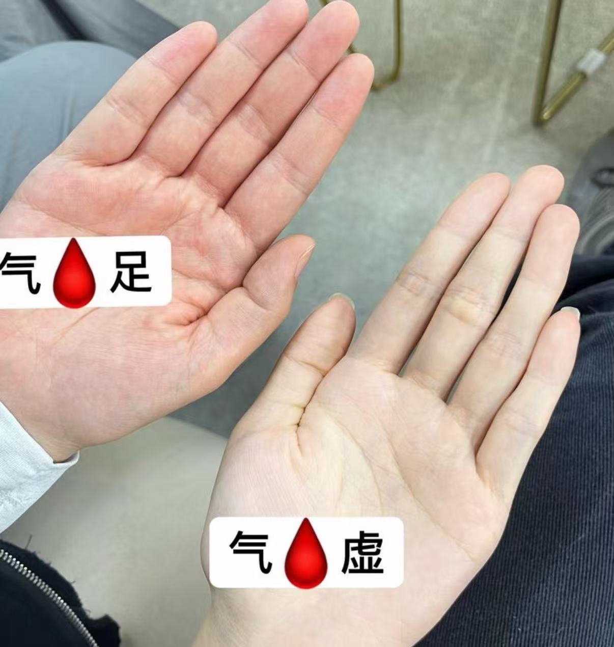 气血足与气血虚的手掌对比：红润与苍白